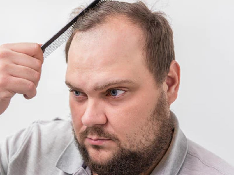 Receding Hairline